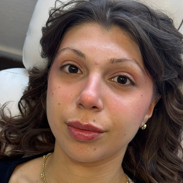 Suna Kaya nachher Lippen