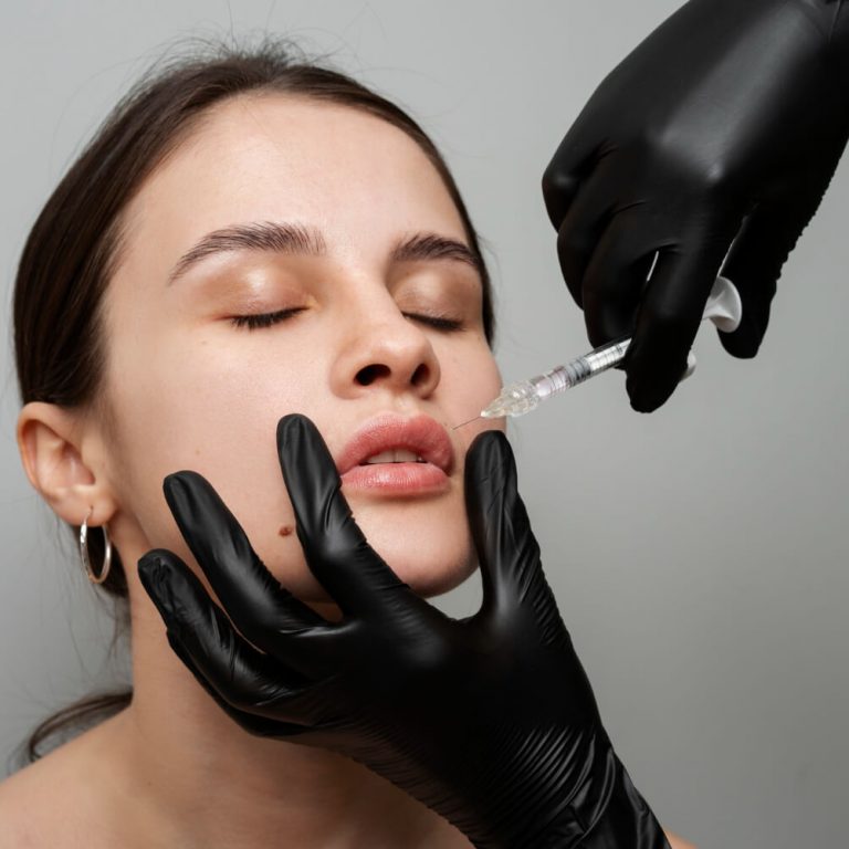Hyaluron Filler Behandlung Vorher/Nachher Beauty by Suna Kaya