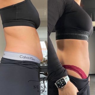 Instagram: Vorher nachher Bauch bei Suna Kaya